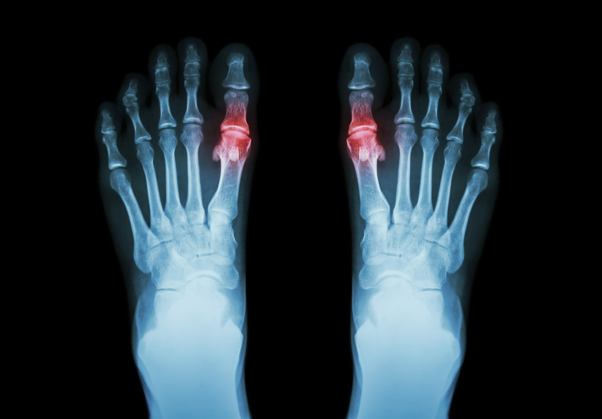 Cartiva Implant Xray